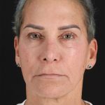 CO2 Laser Before & After Patient #2878