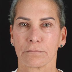 CO2 Laser Before & After Patient #2878