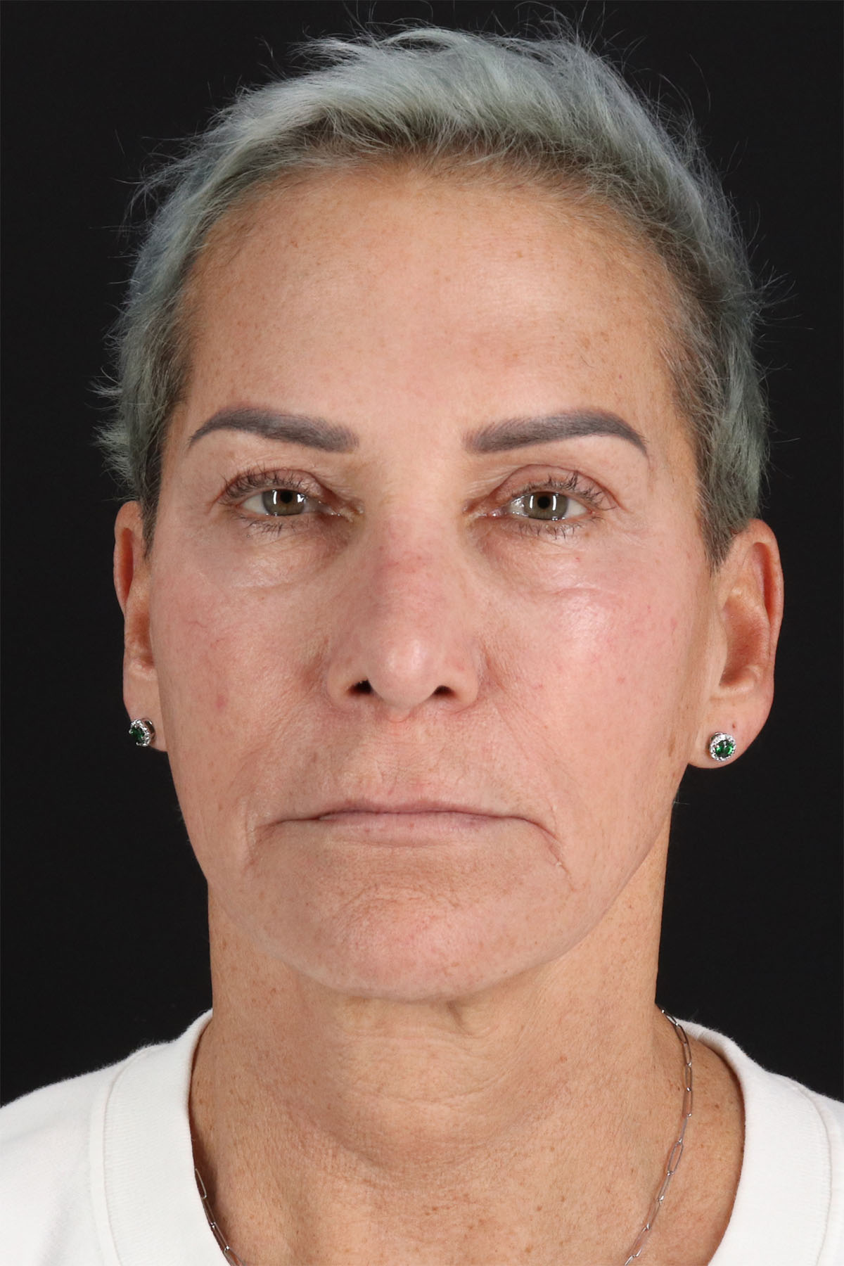 CO2 Laser Before & After Patient #2878