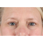 Eyelid Surgery Before & After Patient #2879