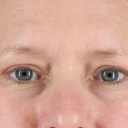 Eyelid Surgery Before & After Patient #2879