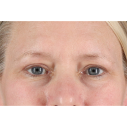 Eyelid Surgery Before & After Patient #2879