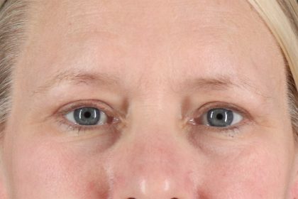 Eyelid Surgery Before & After Patient #2879