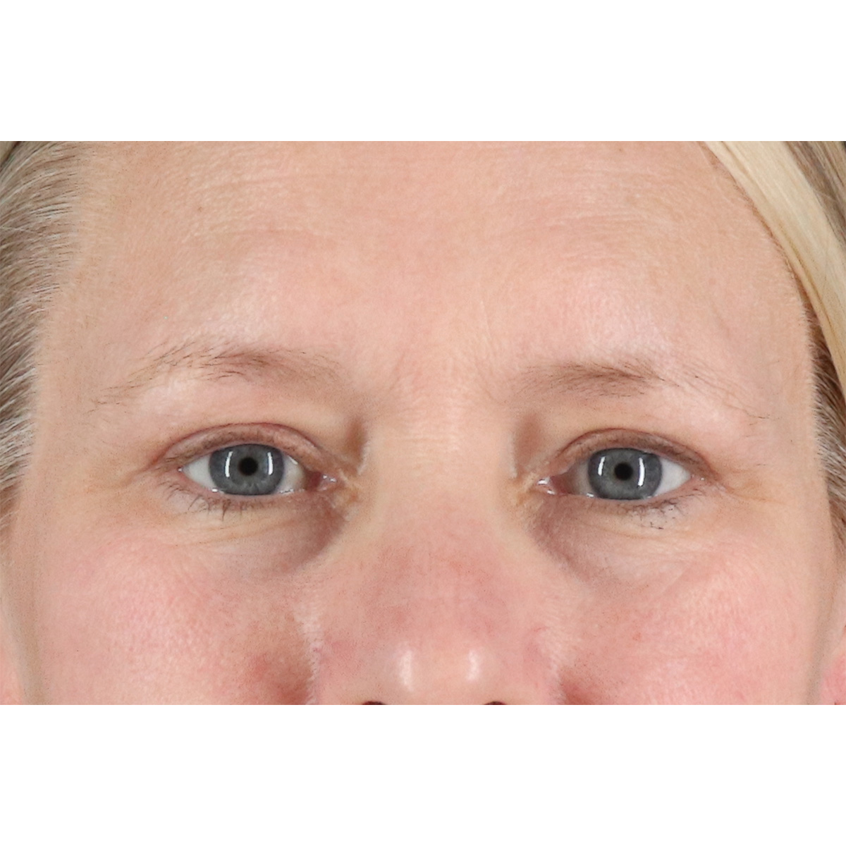 Eyelid Surgery Before & After Patient #2879