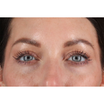 Eyelid Surgery Before & After Patient #2882