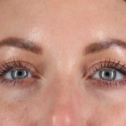 Eyelid Surgery Before & After Patient #2882