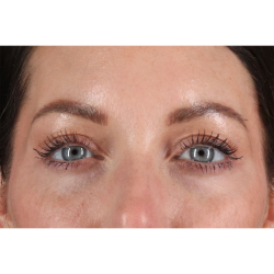 Eyelid Surgery Before & After Patient #2882