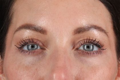 Eyelid Surgery Before & After Patient #2882