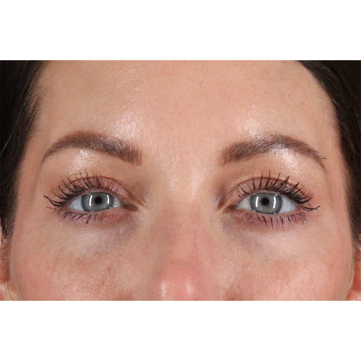 Eyelid Surgery Before & After Patient #2882