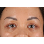 Eyelid Surgery Before & After Patient #2883