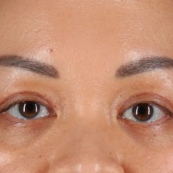 Eyelid Surgery Before & After Patient #2883
