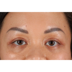 Eyelid Surgery Before & After Patient #2883