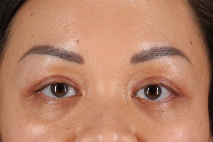 Eyelid Surgery Before & After Patient #2883