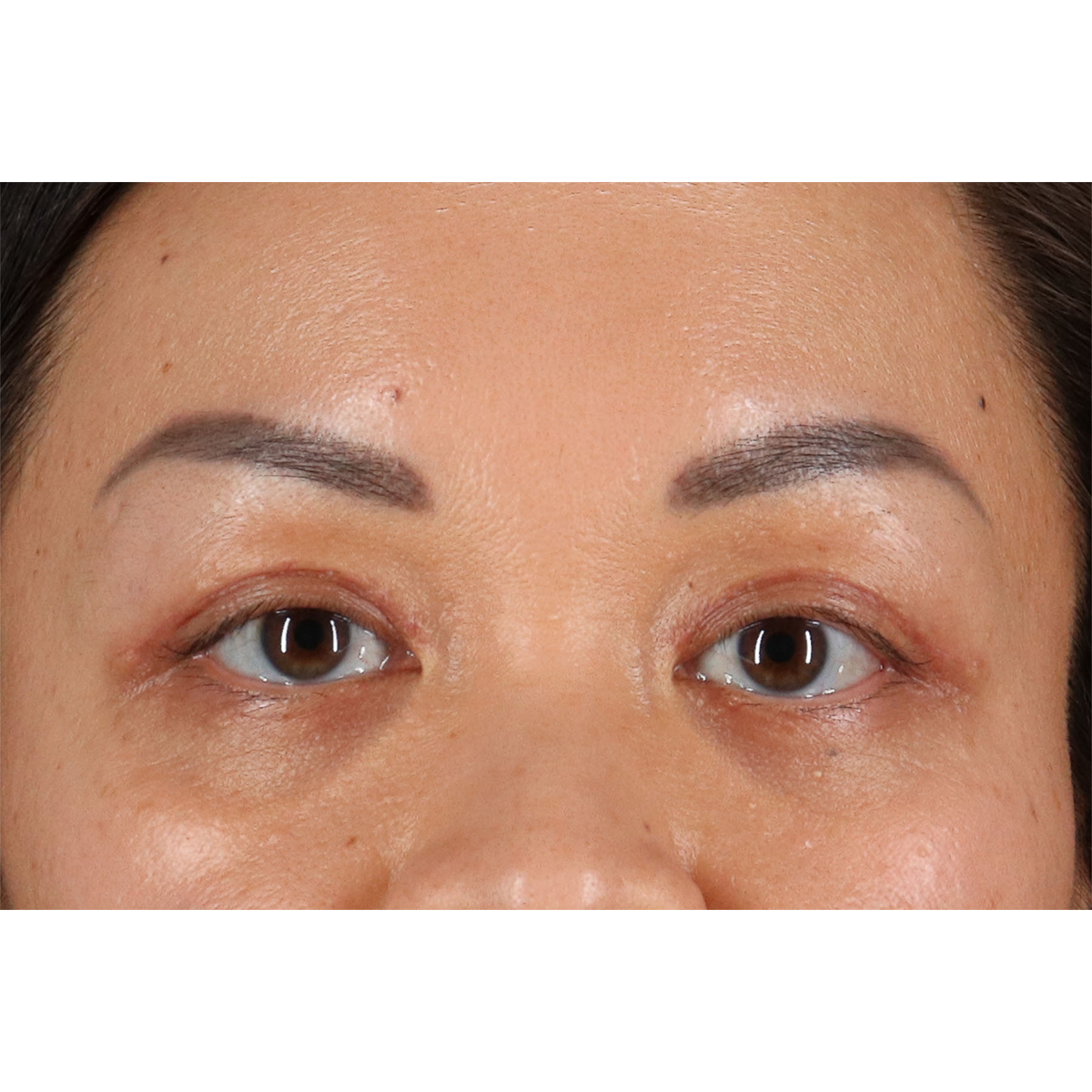 Eyelid Surgery Before & After Patient #2883