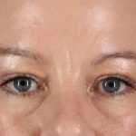 Eyelid Surgery Before & After Patient #2885