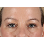 Eyelid Surgery Before & After Patient #2885