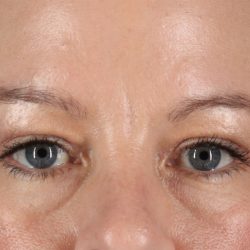 Eyelid Surgery Before & After Patient #2885