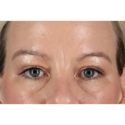 Eyelid Surgery Before & After Patient #2885