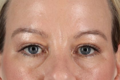 Eyelid Surgery Before & After Patient #2885