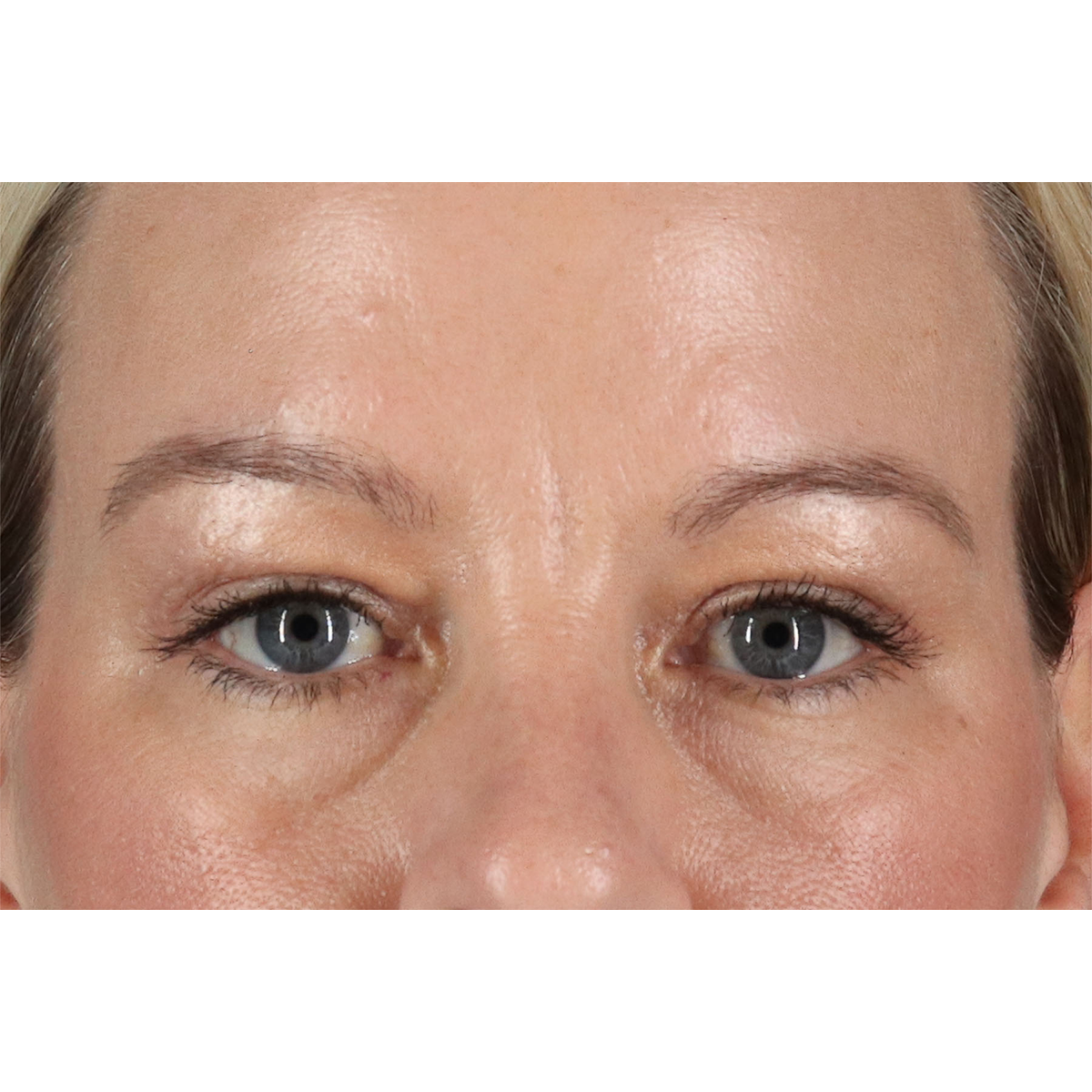 Eyelid Surgery Before & After Patient #2885