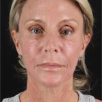 Structural Fat Grafting Before & After Patient #3650