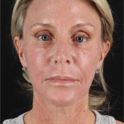 Face Lift Before & After Patient #2886