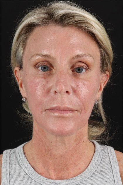 Face Lift Before & After Patient #2886