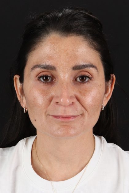 CO2 Laser Before & After Patient #2544