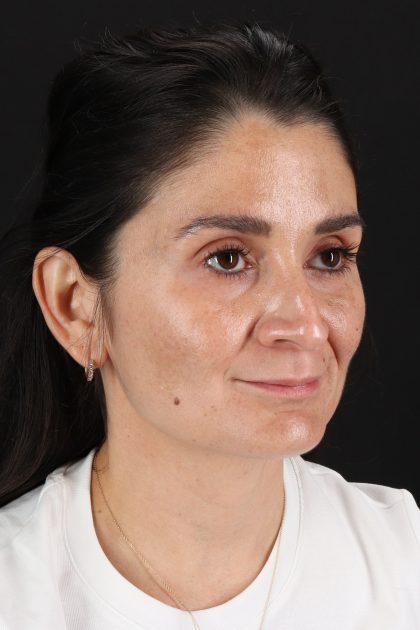 CO2 Laser Before & After Patient #2544