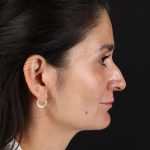 CO2 Laser Before & After Patient #2544