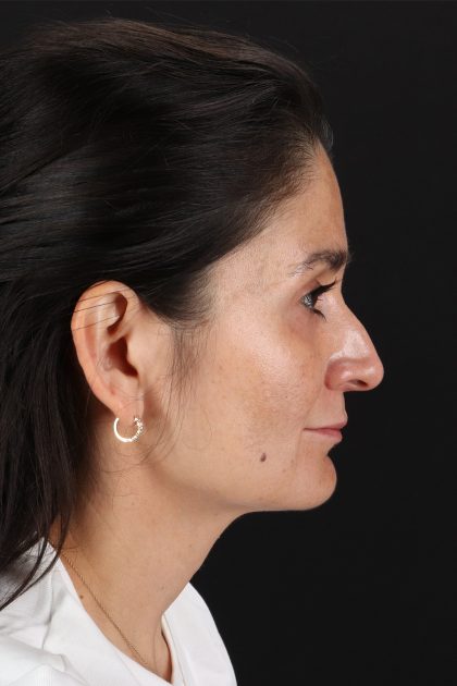 CO2 Laser Before & After Patient #2544