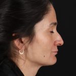 CO2 Laser Before & After Patient #2544