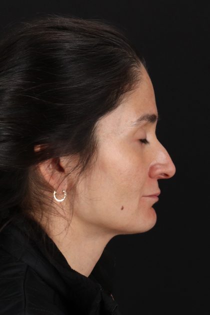 CO2 Laser Before & After Patient #2544