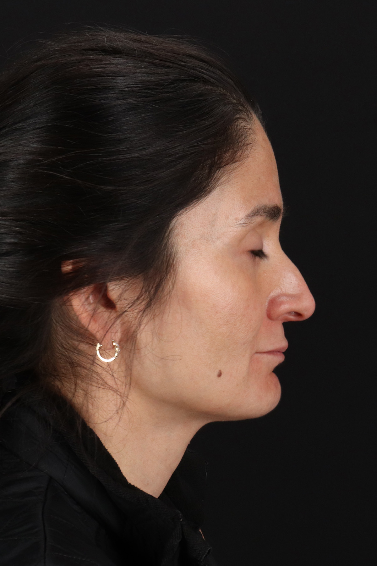 Laser Before & After Patient #2544