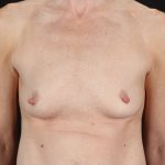Breast Augmentation with Implants Before & After Patient #2546
