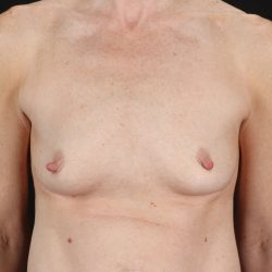 Breast Augmentation with Implants Before & After Patient #2546