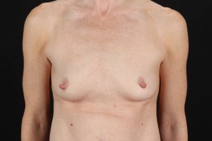 Breast Augmentation with Implants Before & After Patient #2546