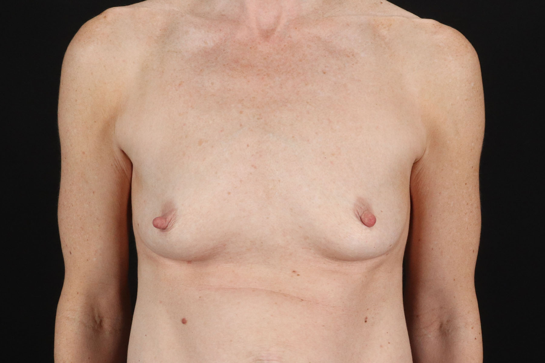 Breast Augmentation with Implants Before & After Patient #2546