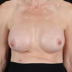 Breast Augmentation with Implants Before & After Patient #2546