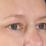 Eyelid Surgery Before & After Patient #2879