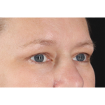 Eyelid Surgery Before & After Patient #2879