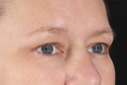Eyelid Surgery Before & After Patient #2879