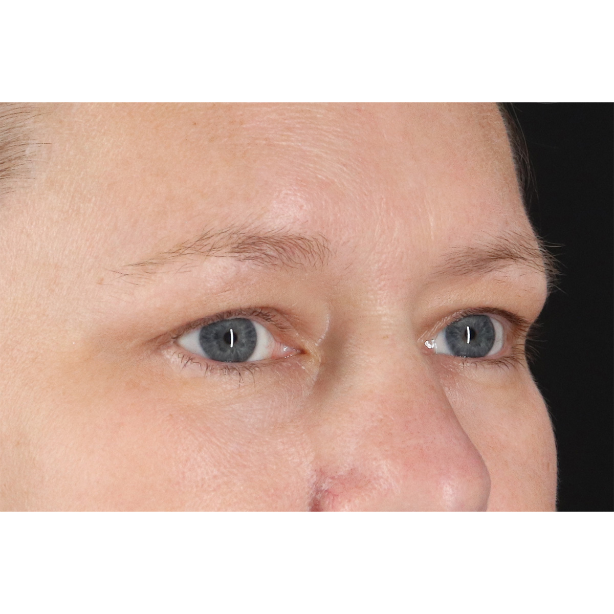 Eyelid Surgery Before & After Patient #2879