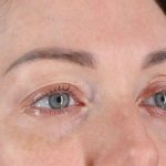 Eyelid Surgery Before & After Patient #2882