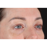 Eyelid Surgery Before & After Patient #2882