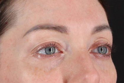 Eyelid Surgery Before & After Patient #2882