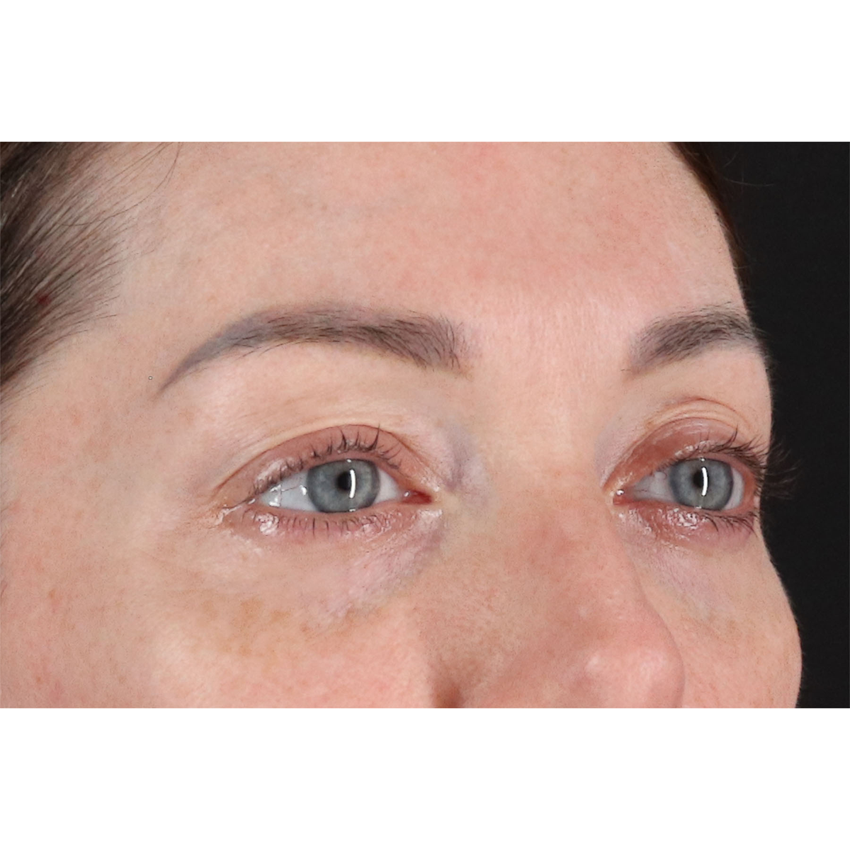 Eyelid Surgery Before & After Patient #2882
