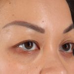 Eyelid Surgery Before & After Patient #2883