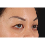 Eyelid Surgery Before & After Patient #2883