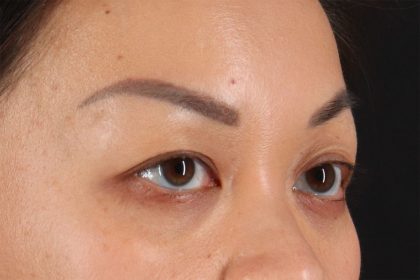 Eyelid Surgery Before & After Patient #2883